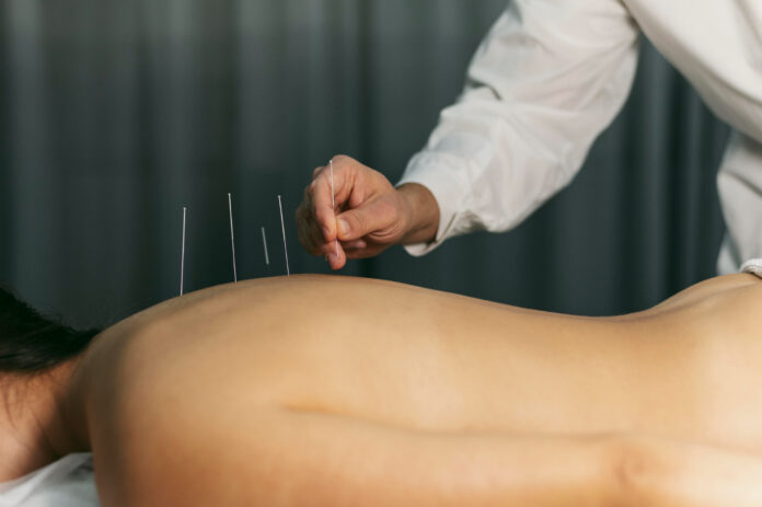 Acupunctura